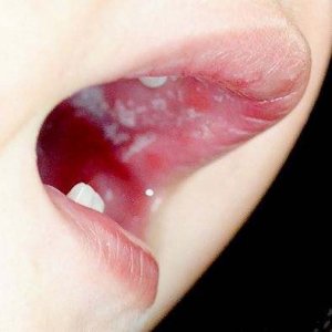 宝宝鹅口疮,你听说过没?
