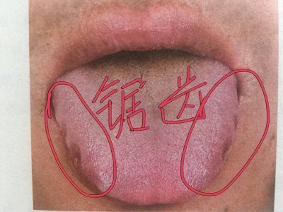 常见8种脾虚舌象,看看你是哪一种?